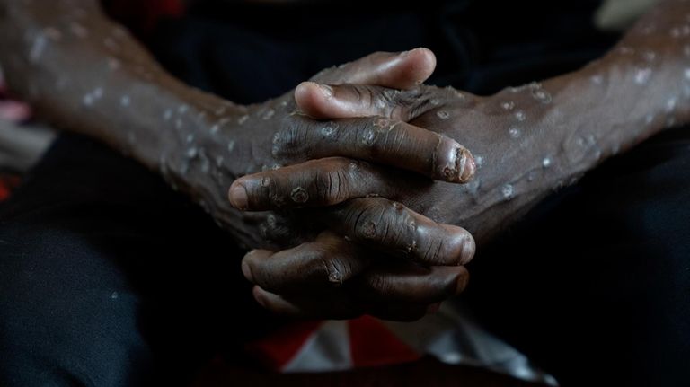 A man suffering from mpox waits for treatment at the...