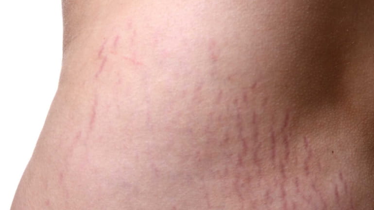 How to Treat Stretch Marks, According to an Expert