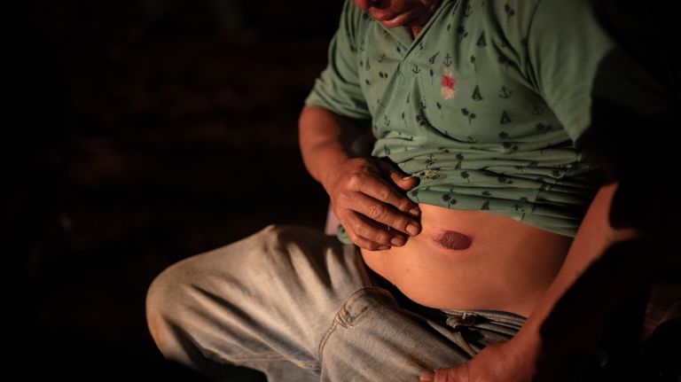 An Indigenous man shows his wound from rubber bullets after...