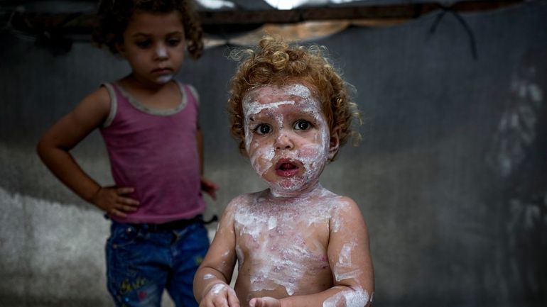 Displaced child Sham al-Hessi, center, who suffers from skin disease,...