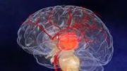 Experts unsure exactly why, but better prevention and after-stroke care...