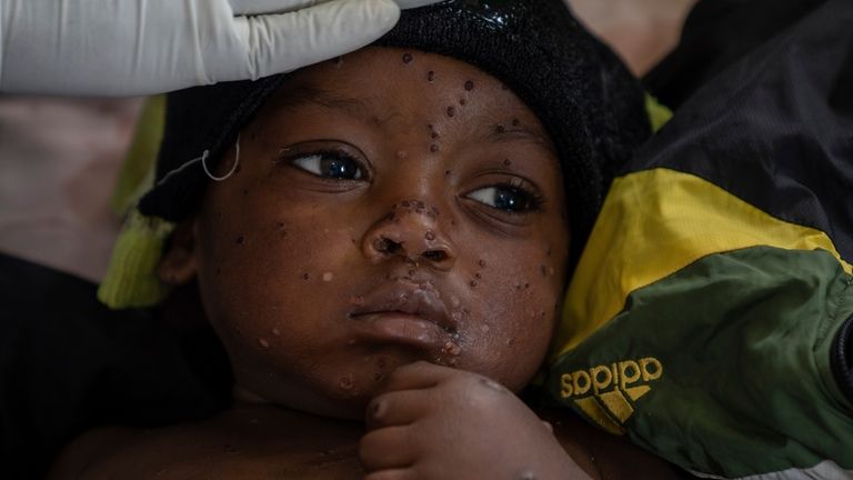 Emile Miango, 2, who has mpox, lies in the hospital,...