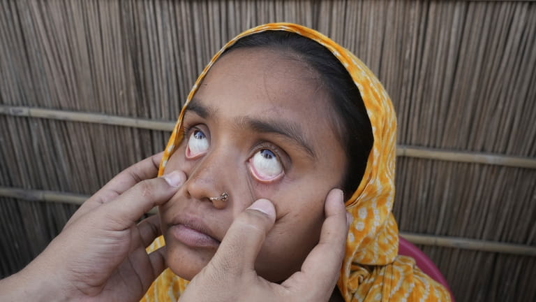 A heart officer checks the eyes of 25-year-old Jahanara Khatoon,...