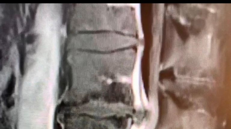 Photo of Frank Esposito's MRI on his back before surgery.