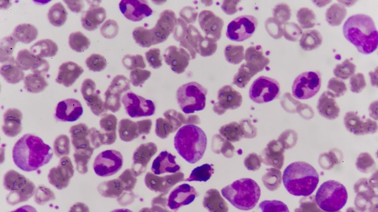 Leukemia blood cells.  Biomarker testing uses information from cancer cells...